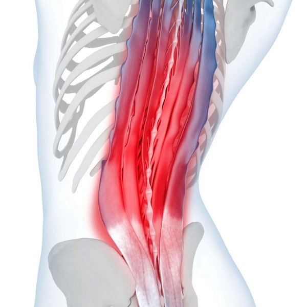 Illustration der Anatomie des Rückens bei Verspannungen. Verspannungen der Rückenmuskulatur führen zu Schmerzen im Bereich der Lendenwirbelsäule. Diese können sich langsam entwickeln oder - wie beim Hexenschuss - plötzlich einschießen.
