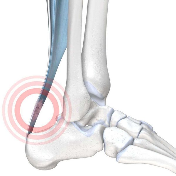 Darstellung der Anatomie der Achillessehne bei einer vorliegenden Achillodynie. Achillodynie ist eine recht häufige Diagnose, die schmerzhafte Prozesse der Achillessehne zusammenfasst.