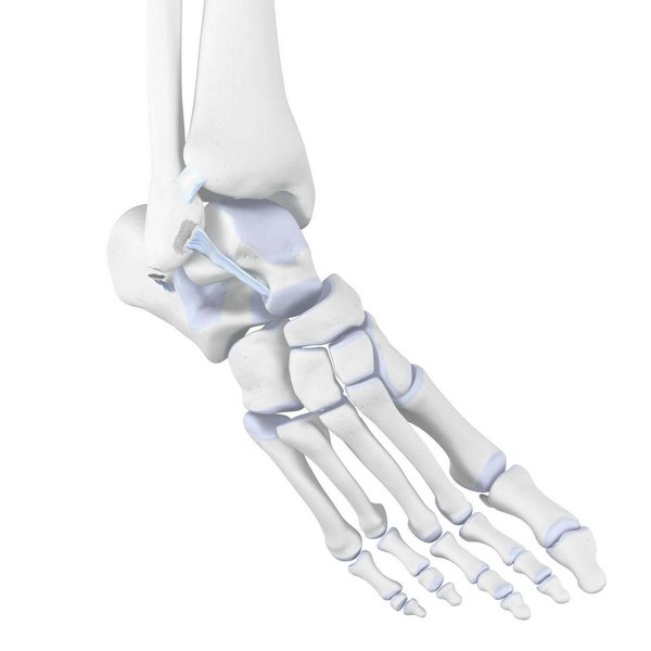 Darstellung der Anatomie des Sprunggelenks bei einer vorliegenden Sprunggelenksdistorsion. Bei einer Sprunggelenksdistorsion werden ein oder mehrere Gelenke mit hoher Krafteinwirkung über ihr physiologisches Maß hinaus bewegt. Die Bänder, welche die Gelenke zusammenhalten, sind alle nur bis zu einem gewissen Maße elastisch und werden bei dieser Überlastung schmerzhaft überstrapaziert.