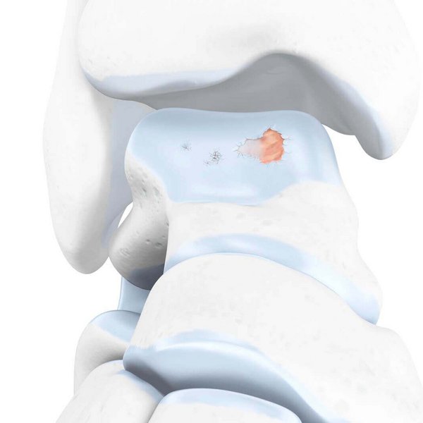 Darstellung der Anatomie des Sprunggelenks mit einer vorliegenden Sprunggelenksarthrose.