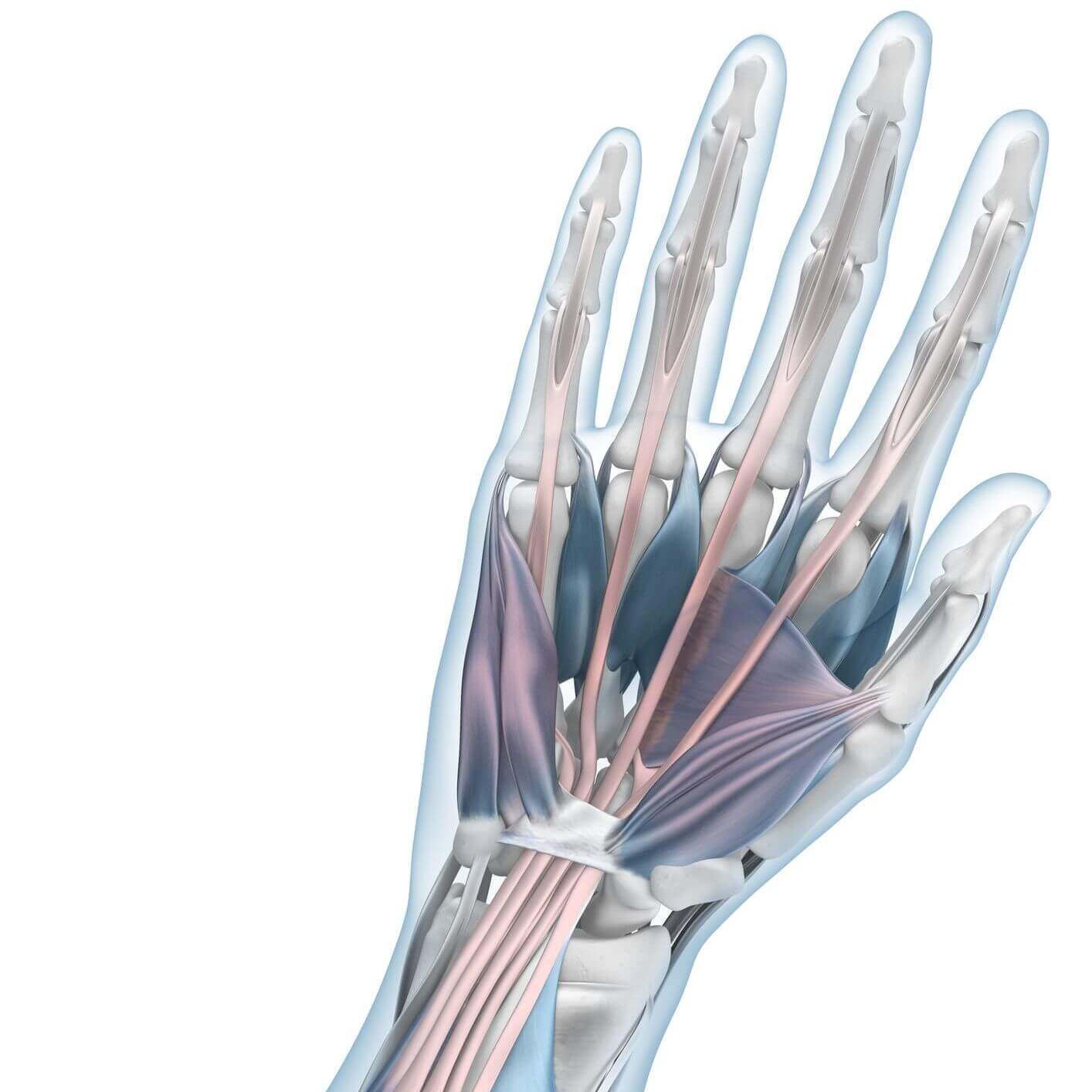 Darstellung der Anatomie des Armes mit einer Mausarm-Erkrankung (RSI-Syndrom).