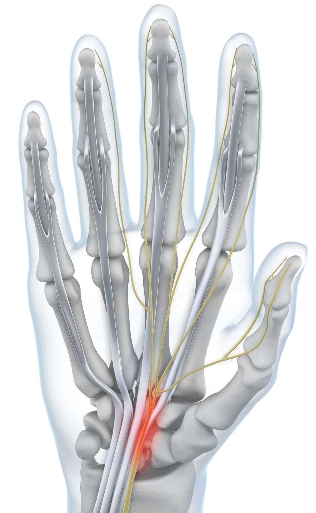 Darstellung der Anatomie der Hand bei einem vorliegenden Karpaltunnelsyndrom.