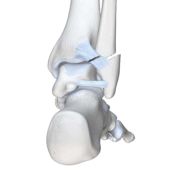 Darstellung der Anatomie eines gebrochenen Sprunggelenks. Bei einer falschen Landung oder einem verdrehten Aufkommen kommt es häufig zu Brüchen im oberen Bereich des Knöchels.
