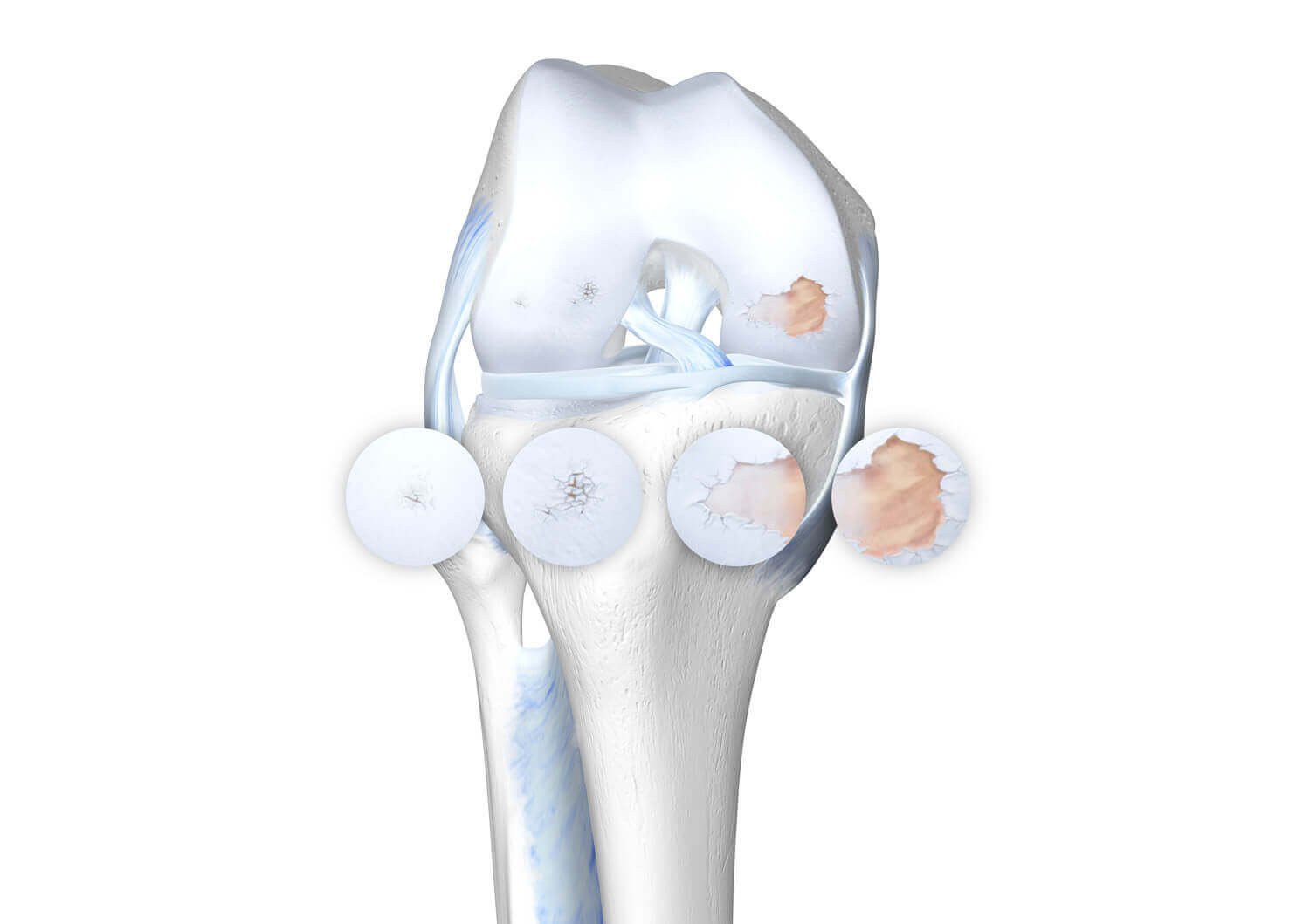 Illustration der Anatomie des Knies bei einer vorliegenden Kniearthrose, inkl. der vier Stadien.