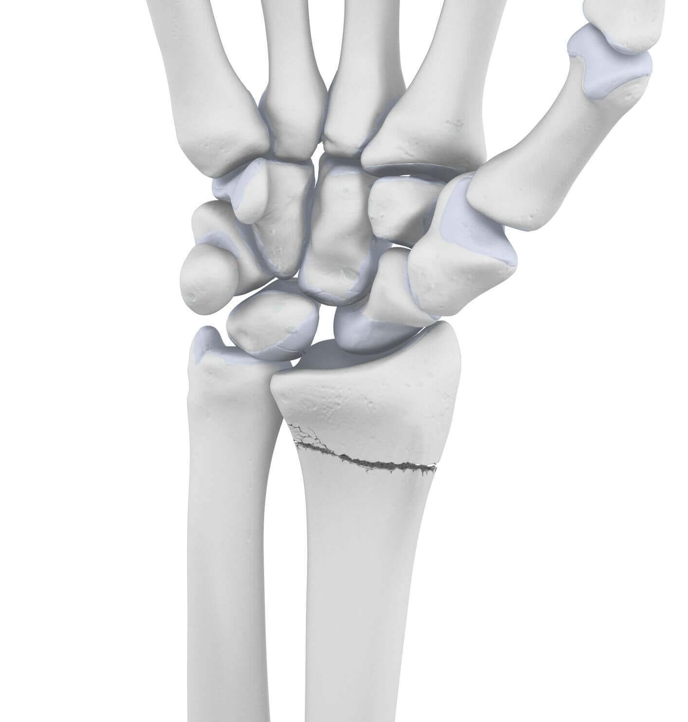 Darstellung der Anatomie der Hand mit einer vorliegenden Radiusfraktur.