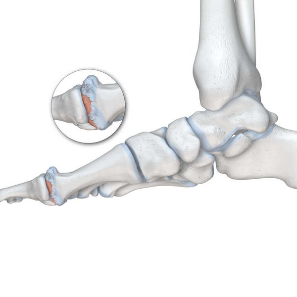 Schematische Darstellung der Anatomie des Fußes mit Fokus auf die Großzehe bei einem vorliegenden Hallux Rigidus.
