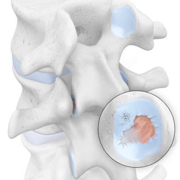 Illustration der Anatomie bei einer vorliegenden Sponylarthrose. Dabei kommt es zur Ausbildung von knöchernen Dornen (Spondylophyten), die im Rahmen des krankhaften Prozesses an den Rändern der Wirbelkörper entstehen können. Treffen diese irgendwann aufeinander, bilden sie neue, knöcherne Verbindungen zwischen den Wirbelkörpern. Das führt zu einer Veränderung der Form der Wirbelsäule, die sich schließlich versteift.