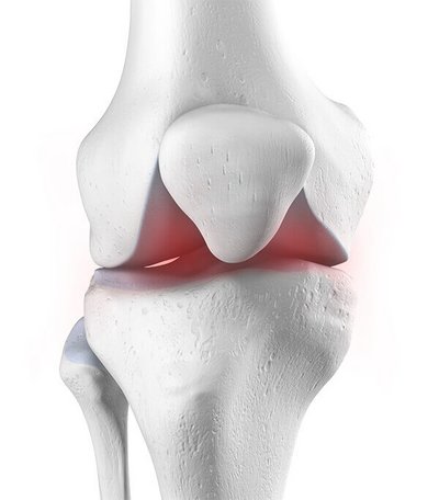 Anatomische Darstellung eines Kniegelenkes, welches von Arthritis betroffen ist.