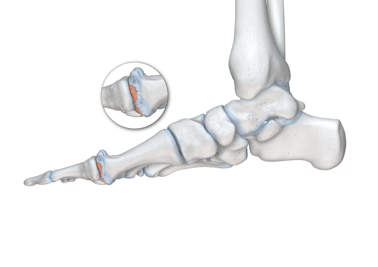 Schematische Darstellung der Anatomie des Fußes mit Fokus auf die Großzehe bei einem vorliegenden Hallux Rigidus.