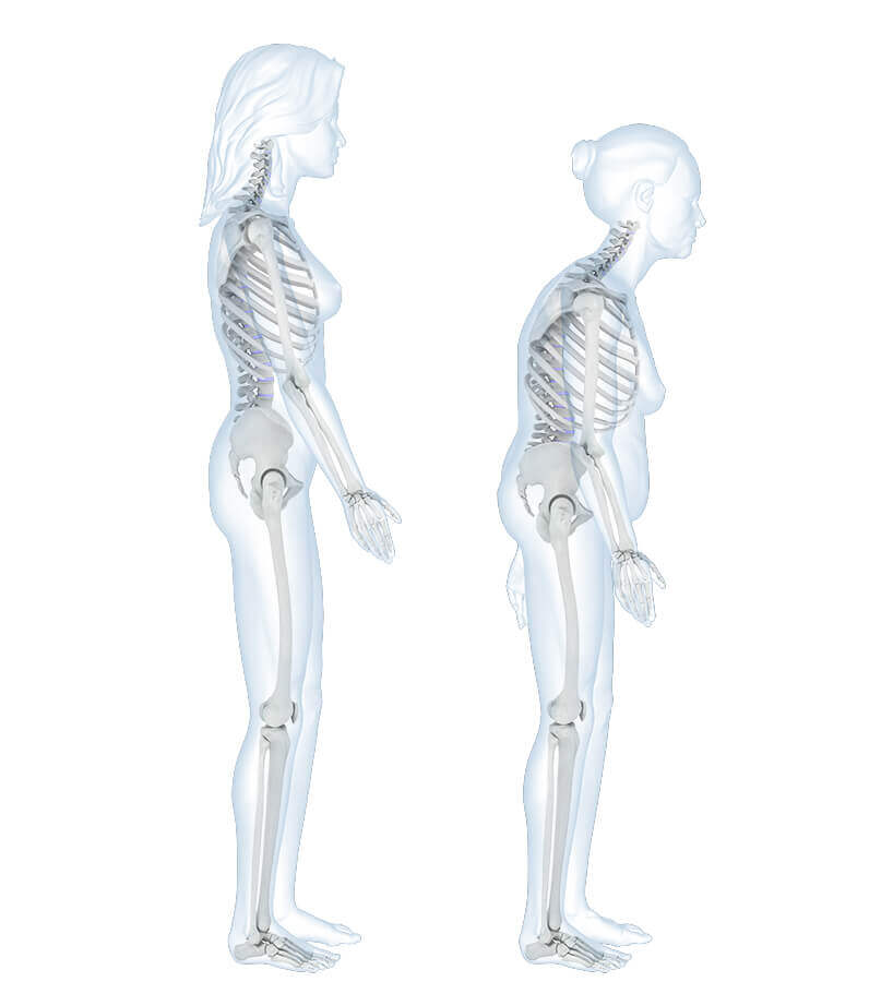 Illustration der Anatomie der Wirbelsäule bei einem Rundrücken. Dabei handelt es sich um eine verstärkte Krümmung des oberen Rückens (der Brustwirbelsäule) nach hinten. Die häufigste Ursache für die Entwicklung eines Rundrückens sind Bewegungsmangel und Haltungsfehler, die über Jahre hinweg anhalten.
