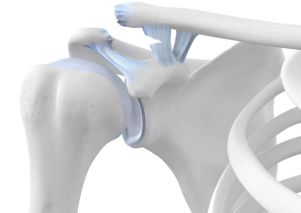 Eine Illustration der Anatomie einer ausgekugelten Schulter.