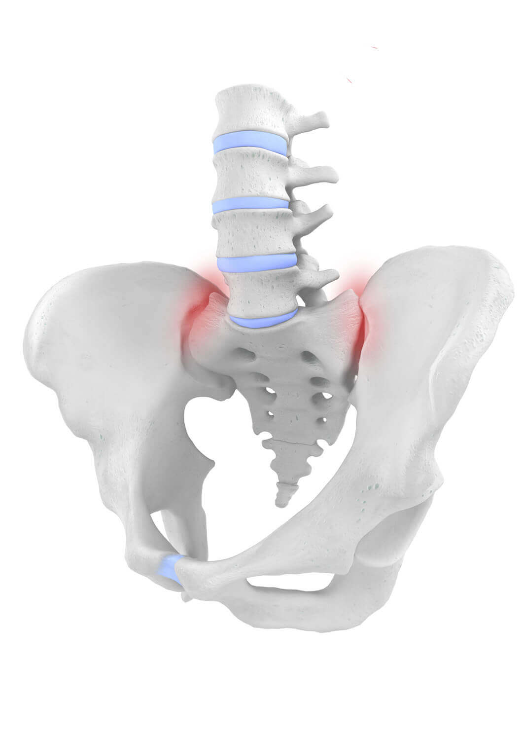 Darstellung der Anatomie des Beckens mit einem ISG-Syndrom (Iliosakralgelenk-Syndrom). Bereits kleinste Verschiebungen im Iliosakralgelenk lösen unter Umständen starke Rückenschmerzen aus.
