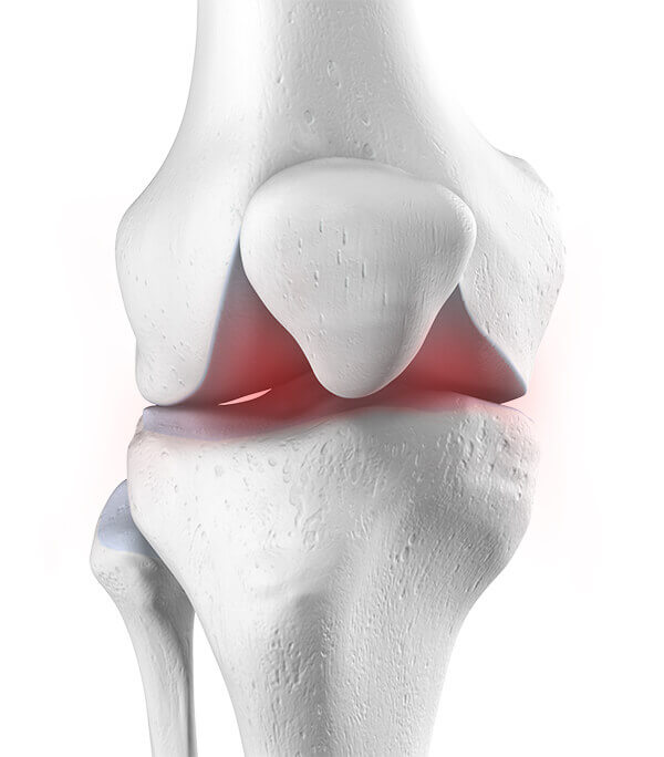 Anatomische Darstellung eines Kniegelenkes, welches von Arthritis betroffen ist.