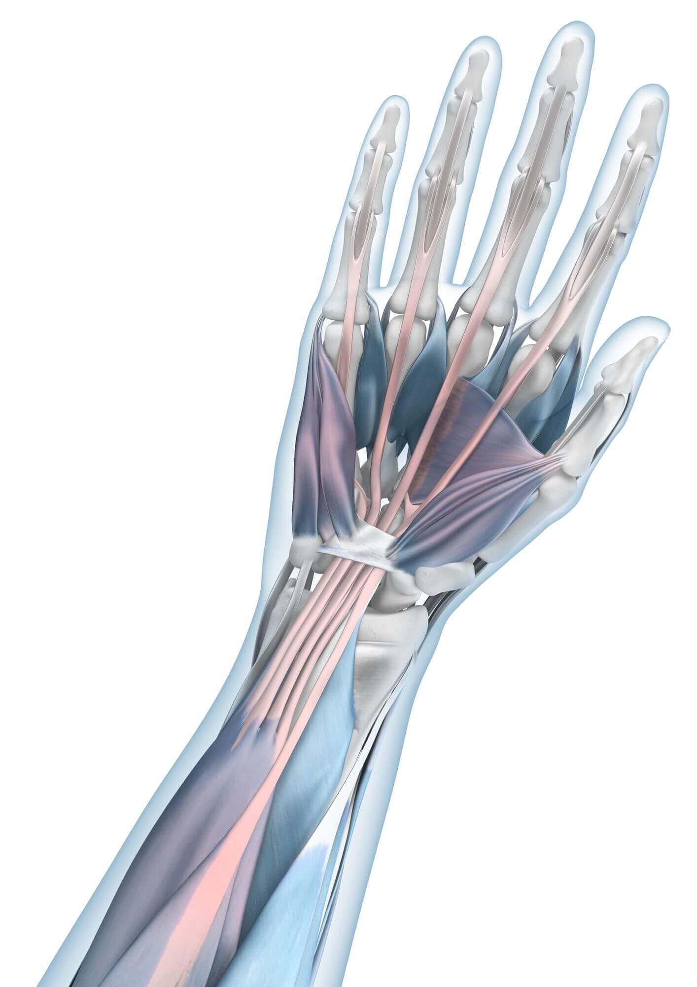 Darstellung der Anatomie des Armes mit einer Mausarm-Erkrankung (RSI-Syndrom).